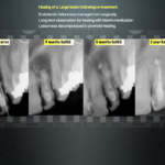 Healing of Large lesion following re-treatment - Endodontics