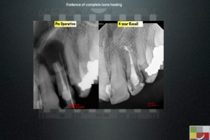 Healing of Large lesion following re-treatment 2 - Endodontics