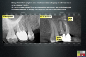 3D Imaging(CBCT) in Endodontics
