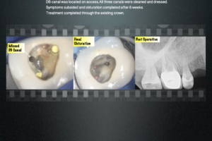 3D Imaging(CBCT) in Endodontics