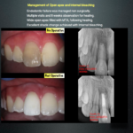 Management of Open apex and Internal bleaching - Endodontics