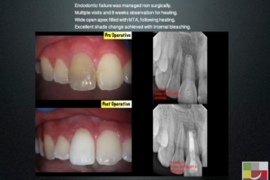 Management of Open apex and Internal bleaching - Endodontics