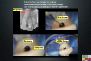 Non Surgical Management of mid root Perforation - Endodontics