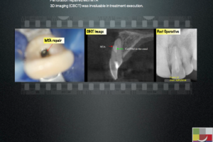 Non Surgical Management of mid root Perforation - Endodontics