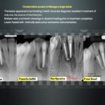 Conservative access to Manage a large lesion - Endodontics