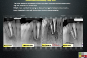 Conservative access to Manage a large lesion - Endodontics