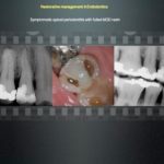Restorative management in Endodontics - Endodontics