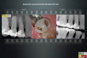 Restorative management in Endodontics - Endodontics