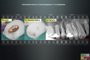 Restorative management in Endodontics 3 - Endodontics
