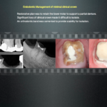 Endodontics Management of minimal clinical crown - Endodontics