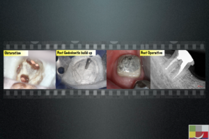Endodontics Management of minimal clinical crown 2 - Endodontics
