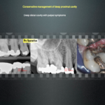 Conservative management of deep proximal cavity 3 - Endodontics