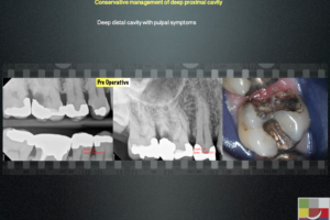 Conservative management of deep proximal cavity 3 - Endodontics