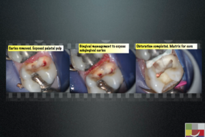 Conservative management of deep proximal cavity 2 - Endodontics