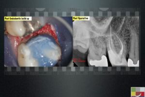 Conservative management of deep proximal cavity - Endodontics