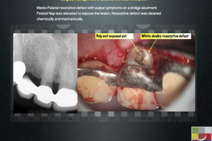Surgical management of External Cervical Resorption 3 - Endodontics