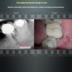 Non Surgical re treatment through a Crown - Endodontics